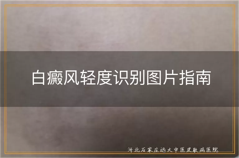 白癜风轻度症状图片,白癜风早期识别方法,白斑初期表现,白癜风自我诊断