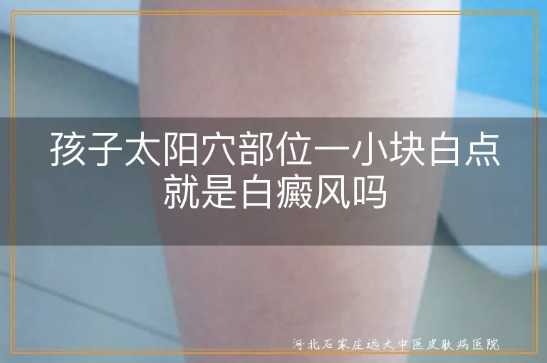 孩子太阳穴部位一小块白点就是白癜风吗