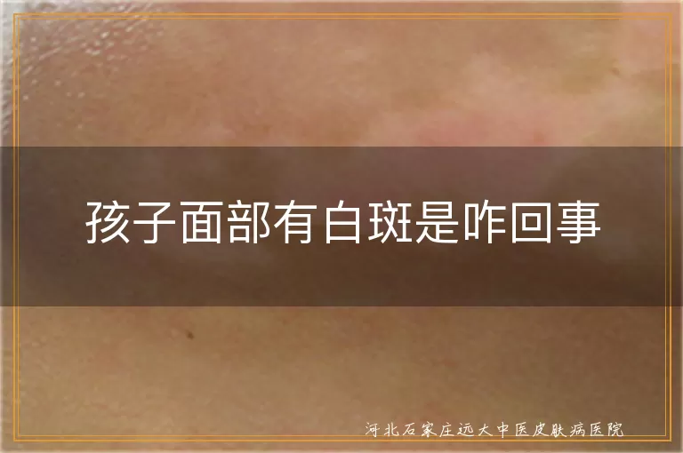 孩子面部白斑原因,白斑可能是白癜风,面部白斑咋治疗,白癜风症状及应对
