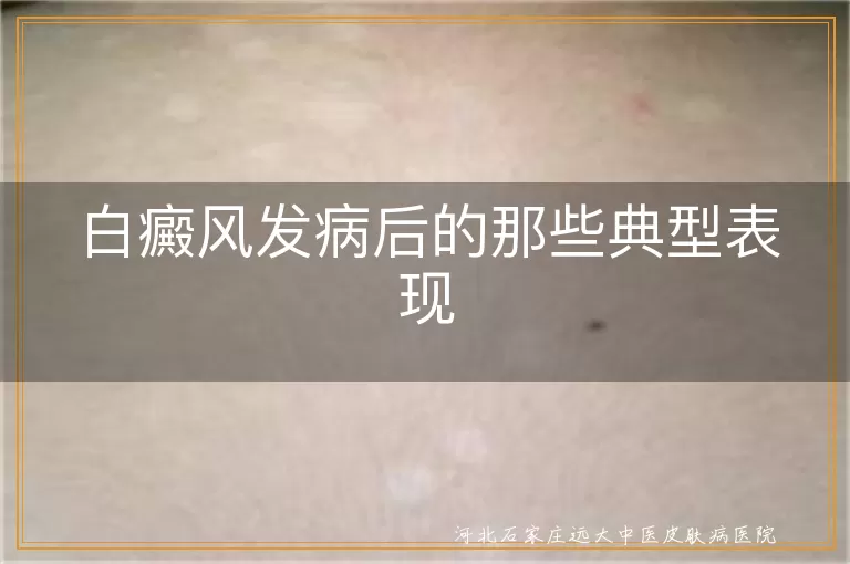 白癜风白斑表现,白癜风皮肤感觉异常,白癜风毛发变白,白癜风伴随症状