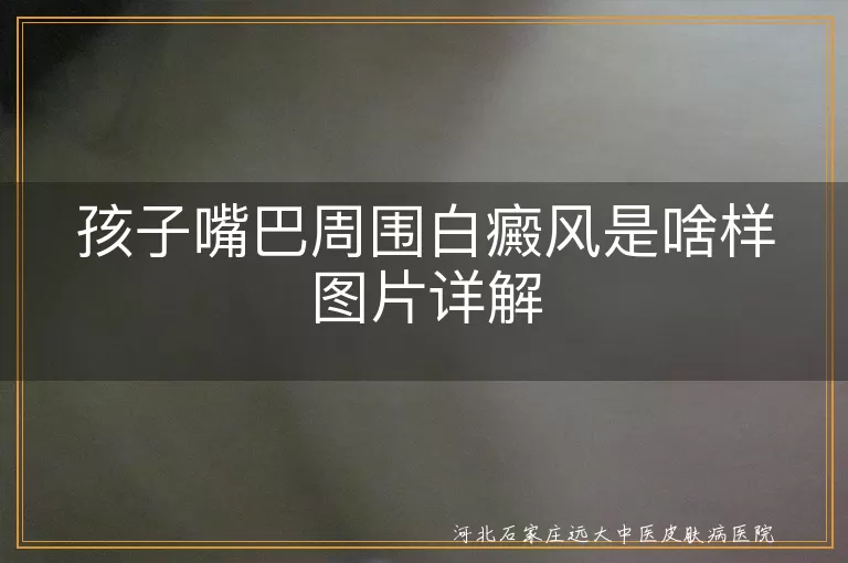 孩子嘴巴白癜风症状,儿童白斑图片展示,白癜风在嘴巴周围表现,儿童白癜风初期图片