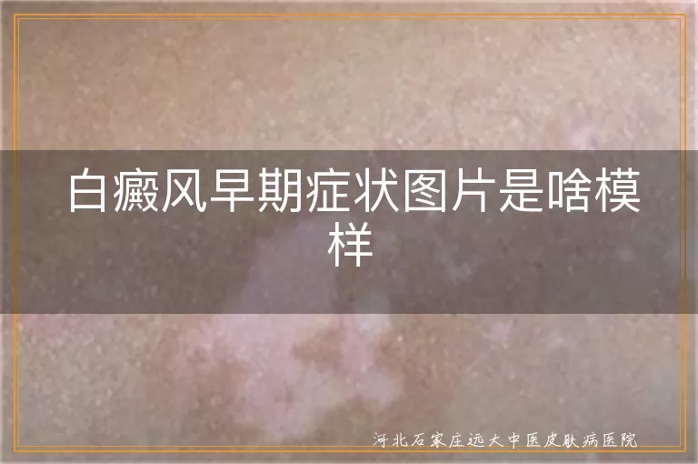白癜风早期症状,白斑颜色形状,白斑边缘特征,预防白癜风方法