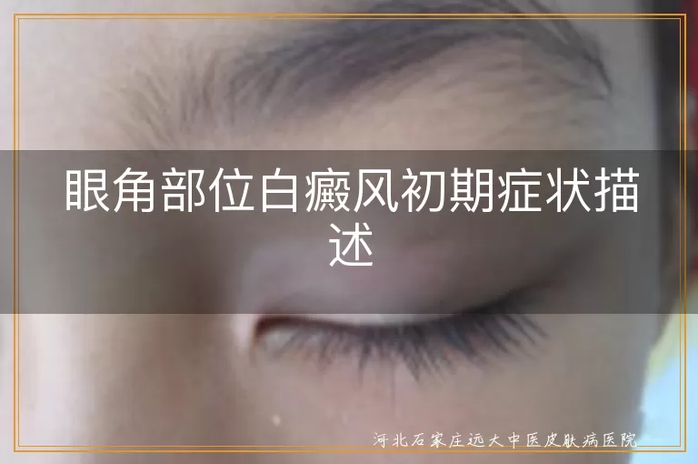 眼角部位白癜风初期症状描述