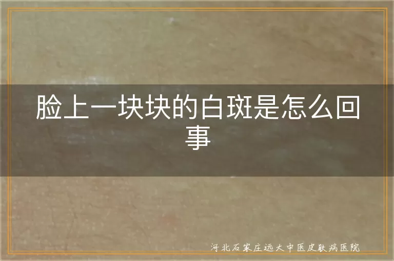 脸上白斑原因解析, 白癜风症状与治疗, 白斑诊断方法, 面部白斑预防护理