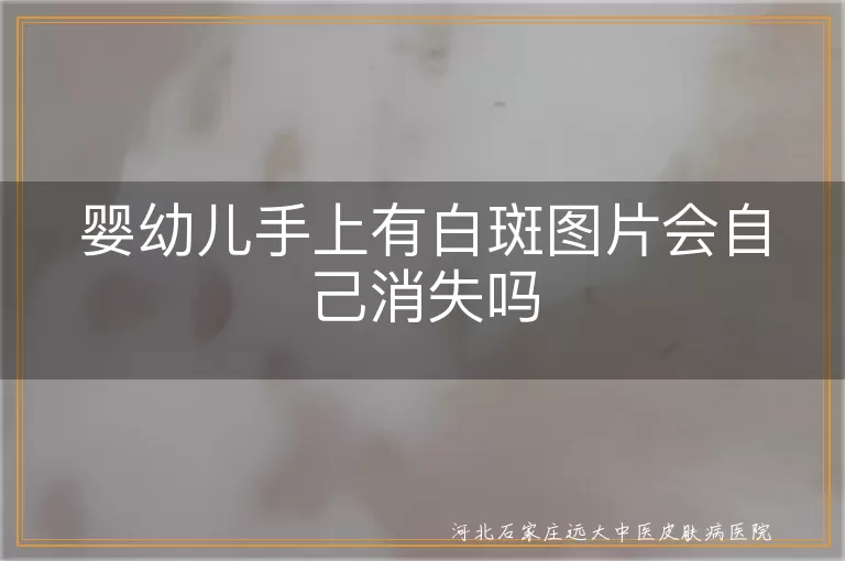 婴幼儿白斑自行消失,白癜风早期症状,白斑原因分析,儿童皮肤健康