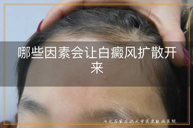 白癜风扩散因素,白斑扩散原因,白癜风治疗不当后果,白斑外伤感染影响