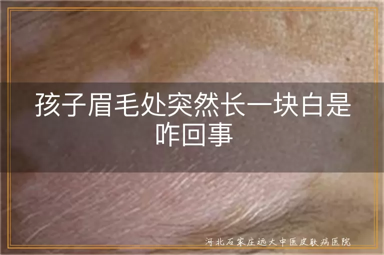 孩子眉毛白斑原因,白癜风治疗方法,儿童白斑预防,营养不良与白斑