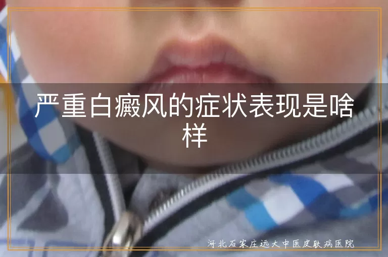 白癜风严重症状,白斑扩散表现,白癜风毛发变白,白癜风皮肤敏感