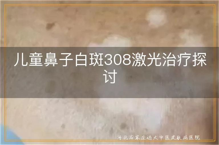 儿童白癜风激光治疗,鼻子白斑308效果,白斑治疗方法,儿童白斑恢复