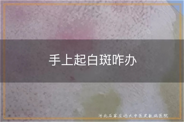 手上白癜风咋治疗,白斑如何恢复色素,白癜风预防方法,白斑生活调理建议