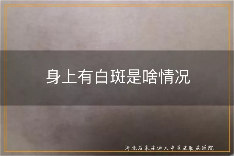白癜风症状,白斑原因,白斑治疗,白斑预防