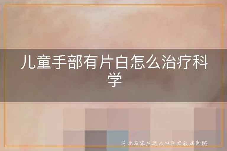 儿童手部白斑治疗指南,白癜风儿童手部治疗,儿童手部白斑科学治疗