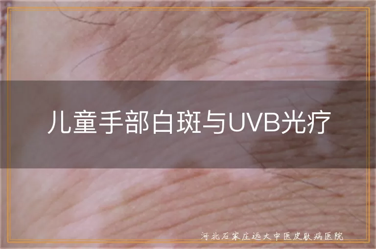 儿童白癜风UVB光疗效果,白斑治疗UVB光疗,白癜风综合治疗UVB光疗