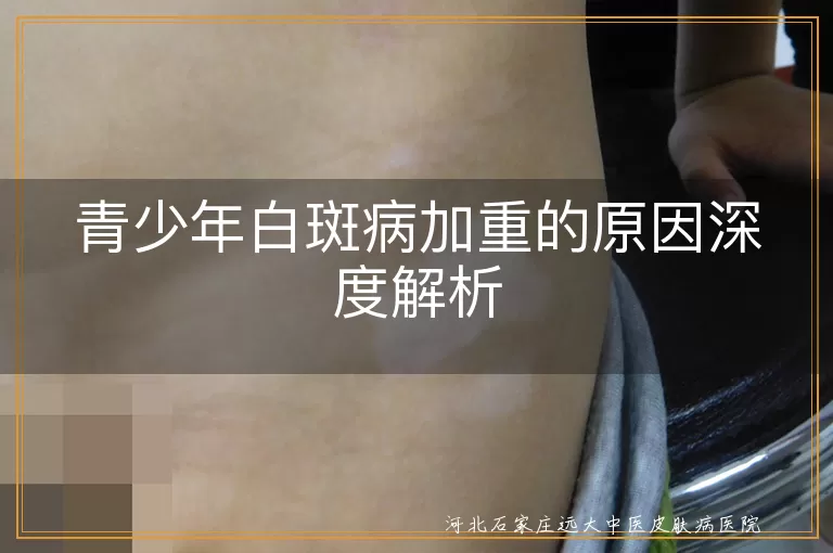 青少年白癜风加重原因解析,白斑病扩散因素探讨,白癜风病情恶化原因深究