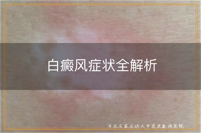 白癜风白斑表现,白癜风皮肤异常感觉,白癜风毛发变白症状