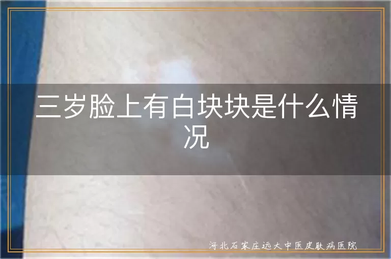 三岁宝宝脸上白斑原因,三岁儿童白癜风症状,幼儿面部白块块解析