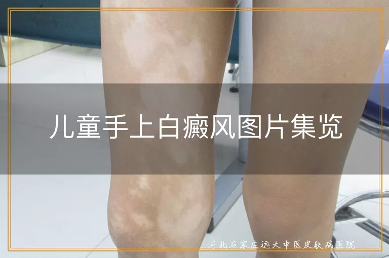 儿童手部白癜风图片,白癜风儿童手部表现,儿童白斑症状图片集
