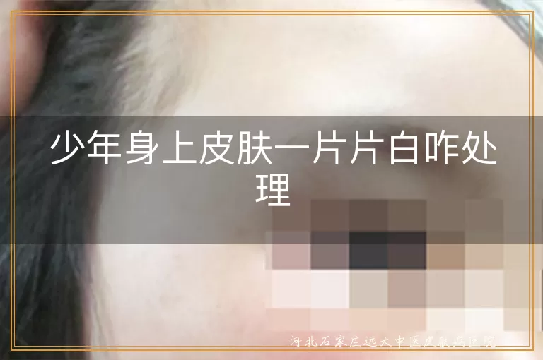 少年白癜风症状,白斑科学治疗方法,预防白癜风复发