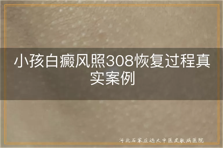 小孩白癜风照308恢复经历,白斑照光后变化,308激光治疗儿童白癜风