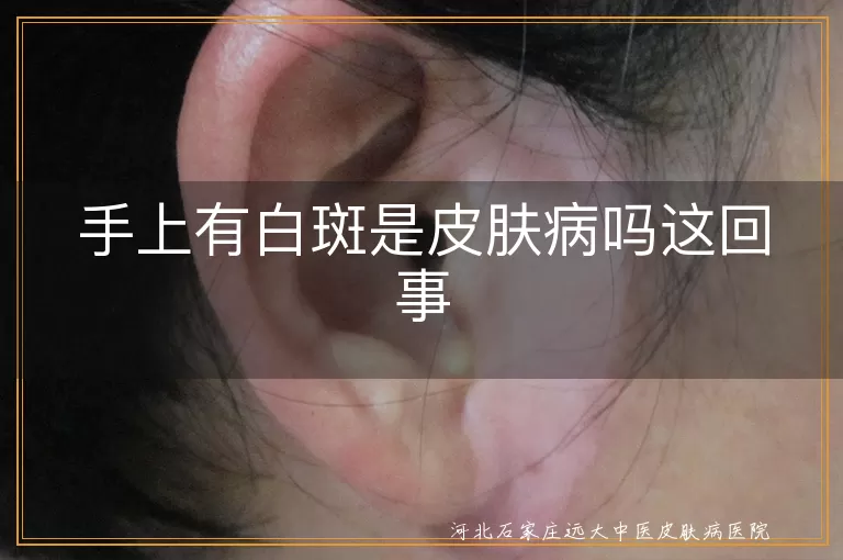 手上白斑是白癜风吗,白斑可能是哪些皮肤病,如何判断手上白斑病因