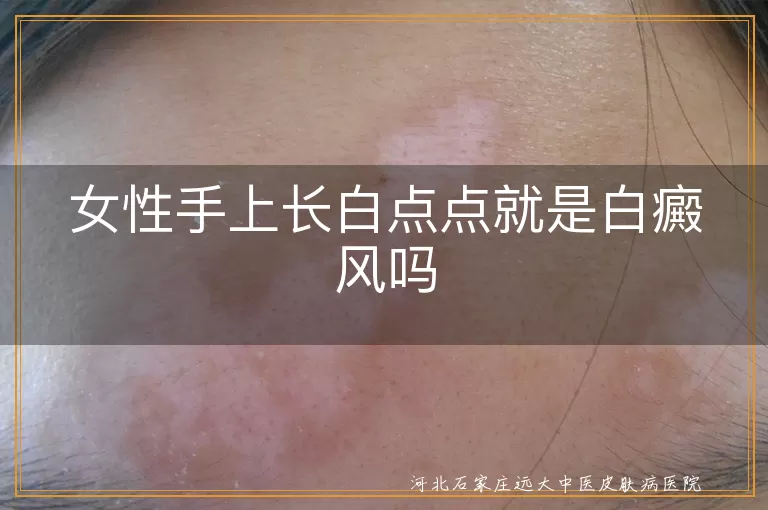 手上白斑可能是白癜风吗,女性白斑病症状,白斑与白癜风区别