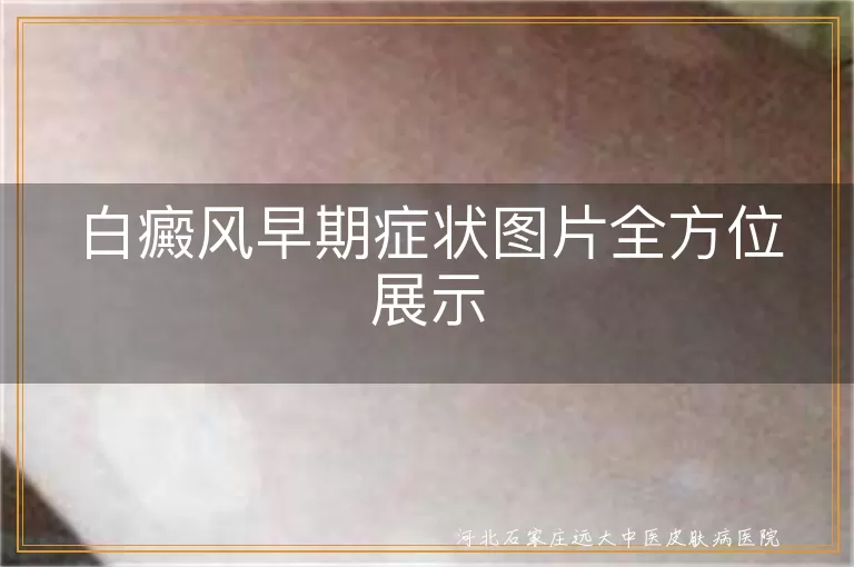 白癜风早期症状图片,白斑初期表现图,白癜风初期白斑图