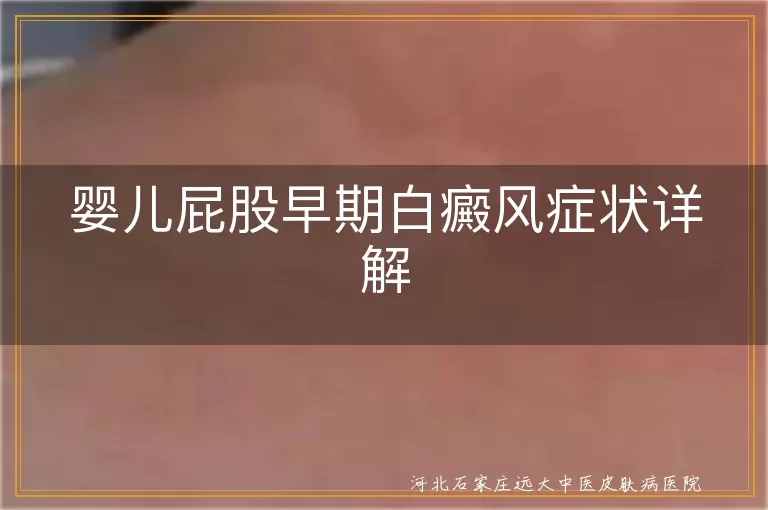 婴儿屁股白癜风初期表现,白斑症状特点,儿童白癜风识别方法