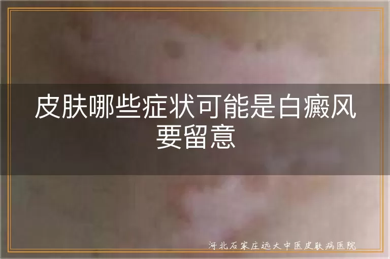皮肤白斑症状,白癜风扩散表现,白斑对光敏感