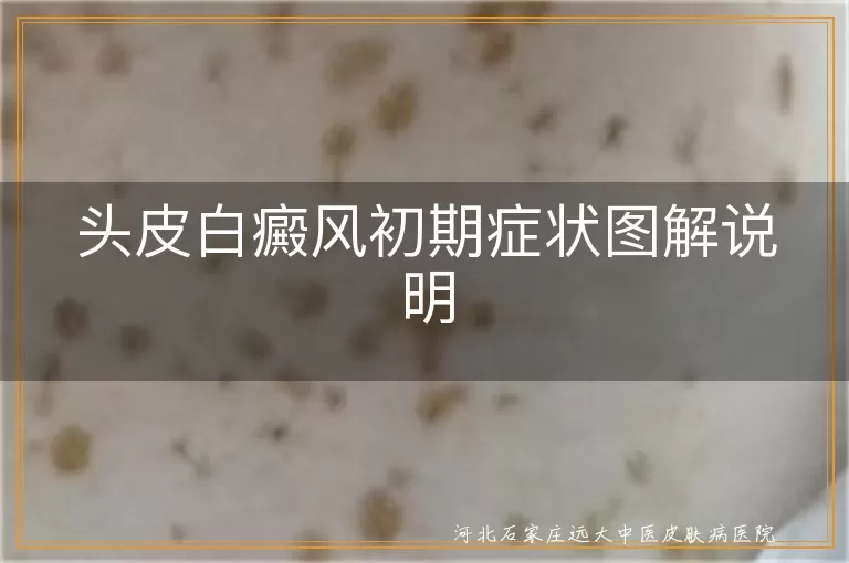 头皮白癜风初期症状,白斑颜色与边界,白癜风早期表现