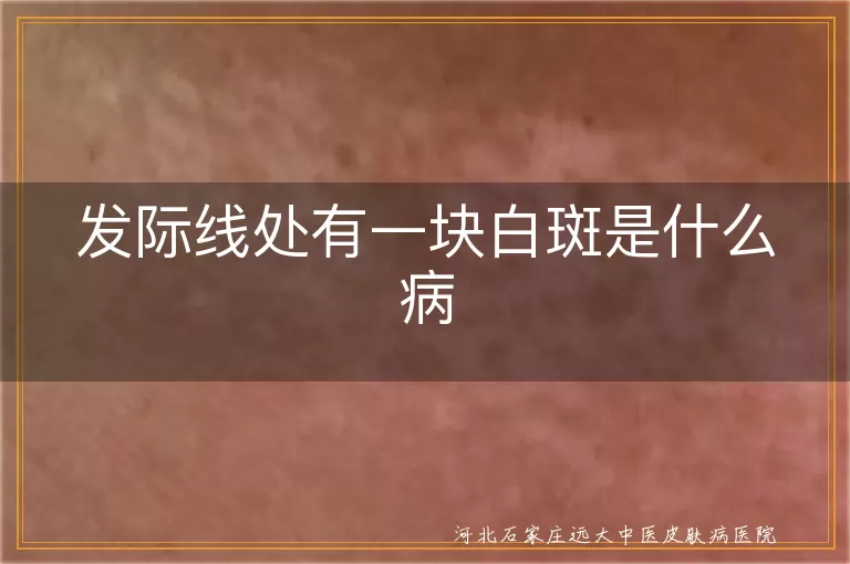 发际线白斑可能是白癜风, 白斑出现在发际线怎么办, 发际线白斑病因揭秘