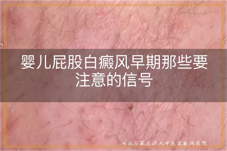 婴儿屁股白癜风初期表现,白斑扩散症状,白癜风皮肤感觉特点