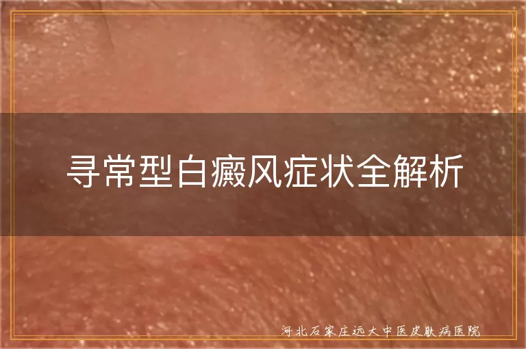 白癜风白斑症状,白癜风感觉异常,白癜风病情变化