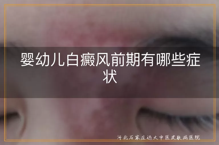 婴幼儿白癜风前期症状,白斑扩散,白癜风毛发变化