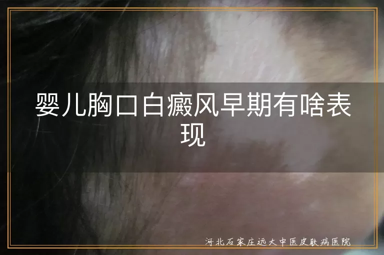 婴儿胸口白癜风初期症状,宝宝白斑扩散表现,儿童白癜风早期信号