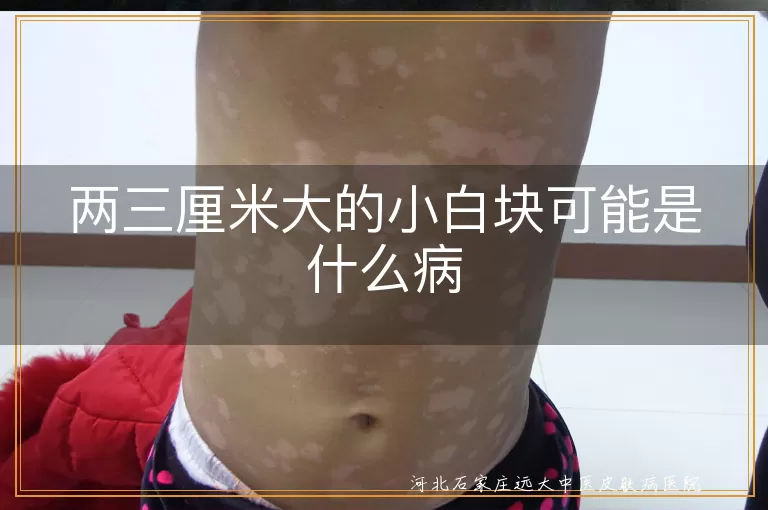 白癜风小白块是什么,皮肤白斑可能疾病,小白块与白癜风关系