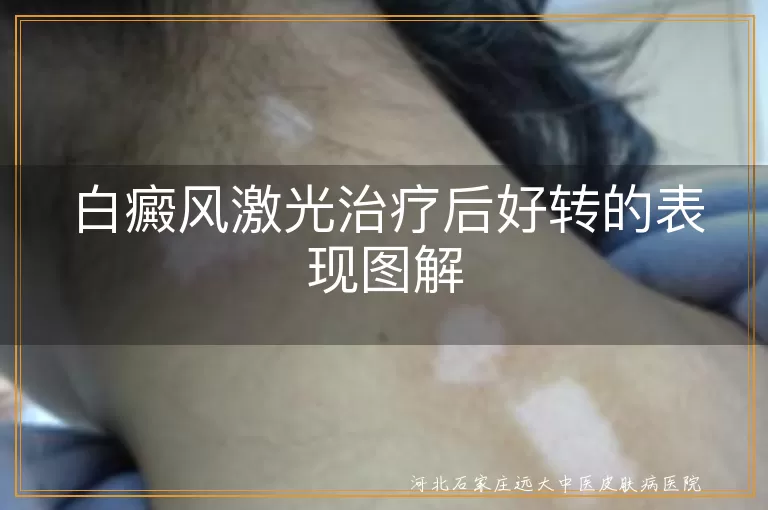 白癜风激光治疗好转表现,白斑色素回归过程,白癜风恢复效果图解