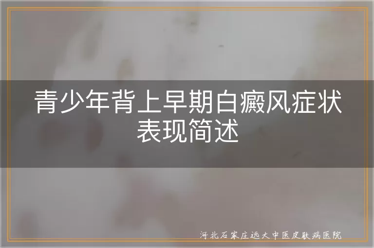青少年背部白癜风初期症状,白斑扩散表现,白癜风早期感觉异常