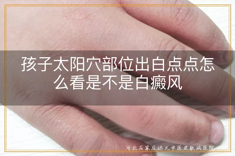 孩子太阳穴白斑如何判断白癜风, 儿童太阳穴白点是否白癜风, 小孩太阳穴白点点与白癜风鉴别