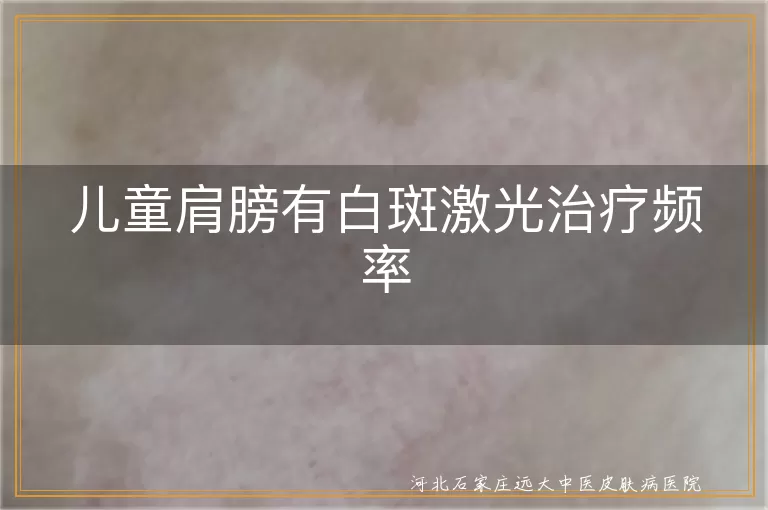 儿童白癜风激光治疗频率,白斑激光治疗次数,儿童白斑激光照射频率