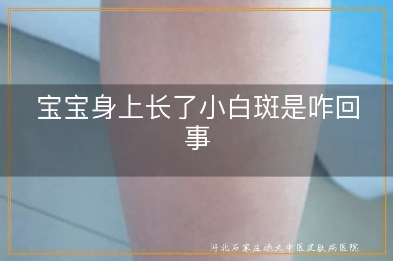 宝宝身上白斑可能是白癜风,宝宝小白斑原因揭秘白癜风,白斑困扰宝宝怎么办