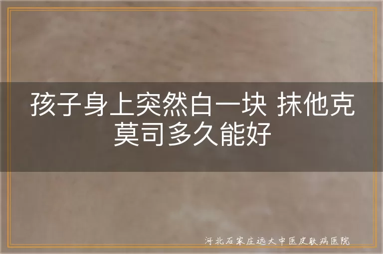 孩子白斑治疗时间 他克莫司软膏白癜风恢复 孩子白癜风多久见效