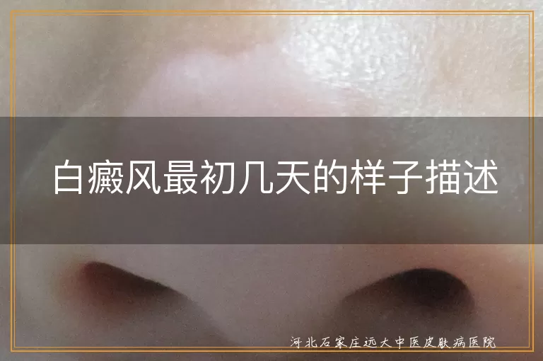 白癜风早期症状,白斑初期表现,白癜风刚开始的样子