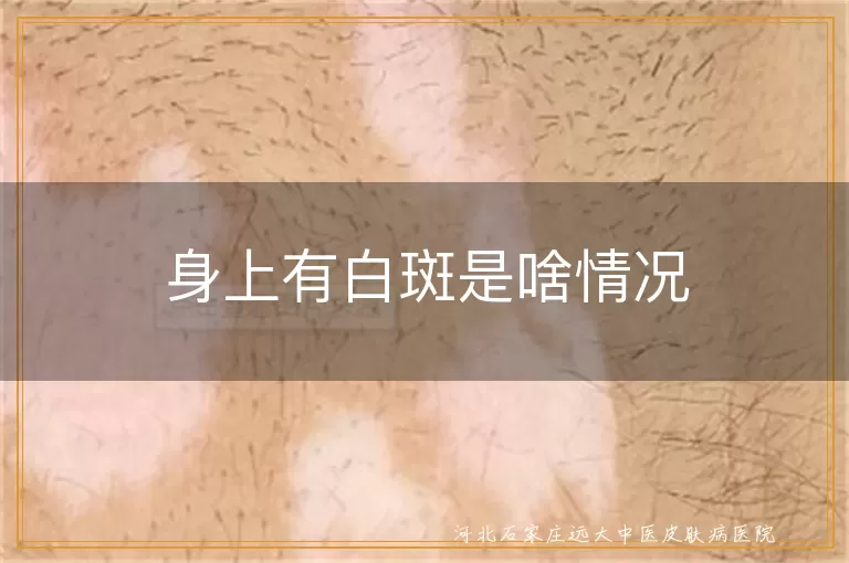 白癜风症状表现,身上有白斑原因,白斑如何预防治疗