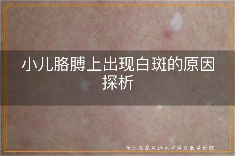 小儿白斑原因探析,白癜风病因分析,胳膊白斑疾病解读