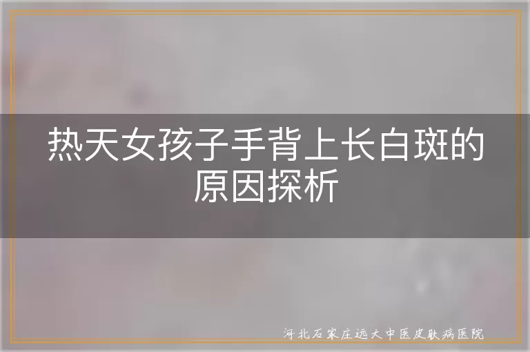 热天手背白斑原因,白癜风症状分析,白斑疾病预防
