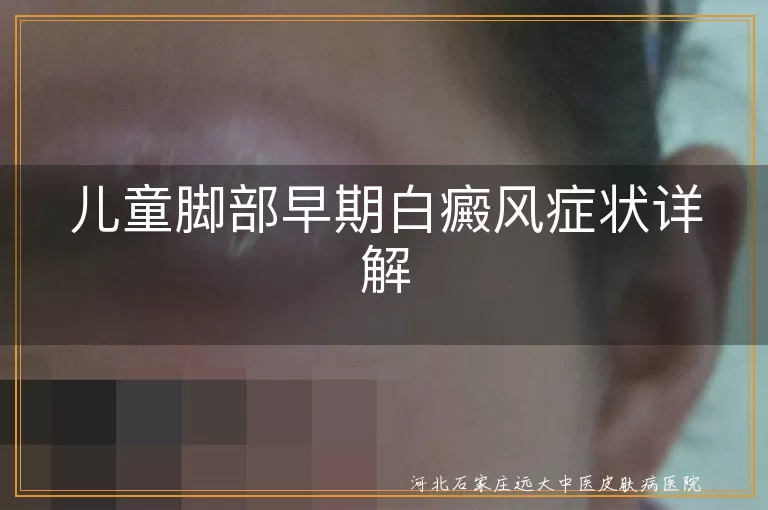 儿童脚部白癜风症状,白斑颜色变化特点,白癜风早期治疗