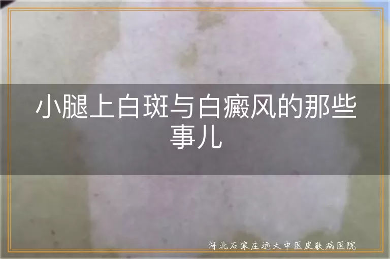 小腿白斑原因多,白癜风特点解析,专业诊断很重要