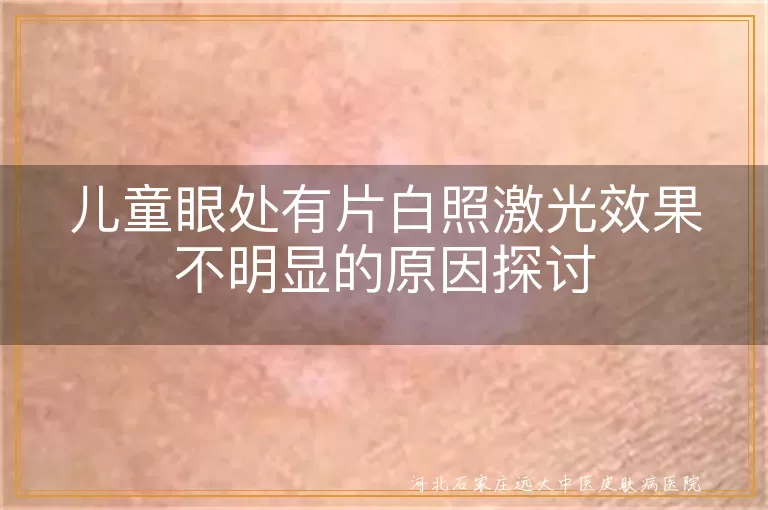 儿童眼处白斑激光治疗不明显原因,儿童白癜风激光治疗探讨,白斑照激光效果不明显怎么办