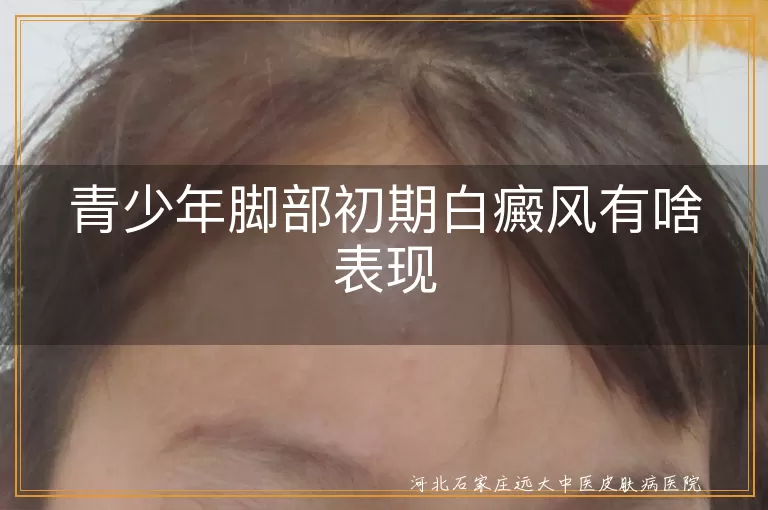 青少年脚部白癜风症状,白斑颜色形状特点,白癜风扩散表现