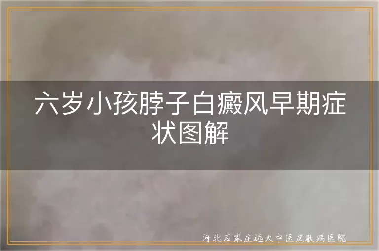 六岁儿童白癜风早期症状,脖子白斑图片特征,儿童白斑识别方法